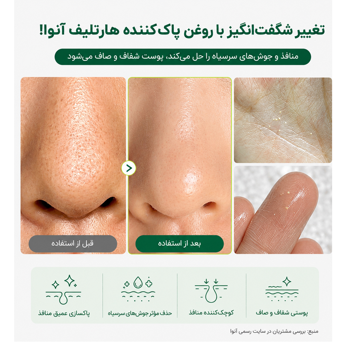 نتیجه استفاده از روغن پاک کننده کنترل منافذ هارتلیف آنوا