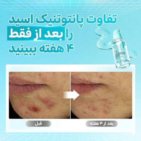 سرم تسکین دهنده و آبرسان پانتنول شماره ۱ نامبوزین 9 نتایج استفاده از سرم نامبوزین