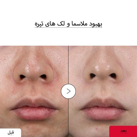 سرم اکوال بری برای بهبود ملاسما