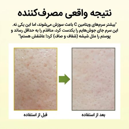 قبل و بعد سرم ارنسیا