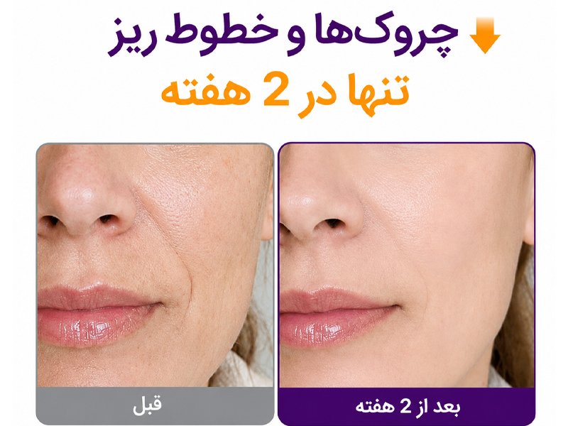 تاثیر دو هفته ای سرم ضدچروک رتینول رتینال +NAD 2000 پوریتو